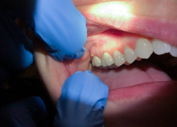 Best Knocked-Out Tooth Emergency  in Kent, OH