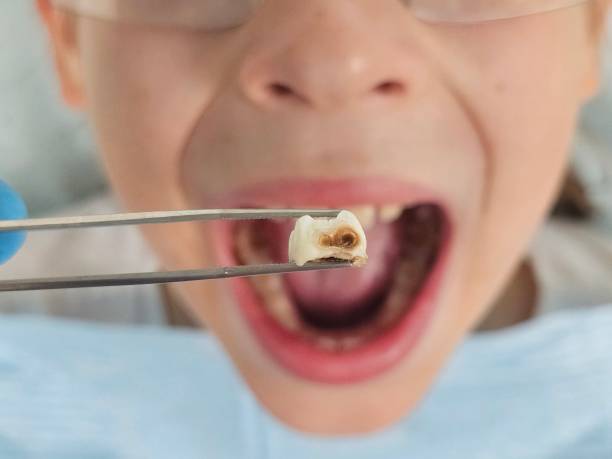 Best Emergency Tooth Extraction  in Kent, OH