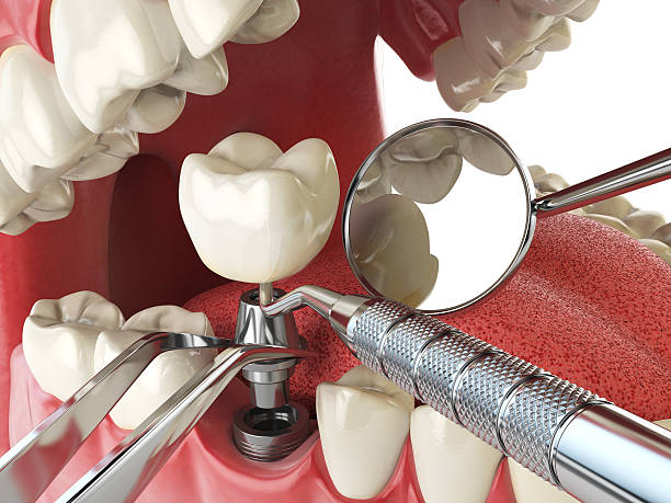 Teeth Whitening in OH